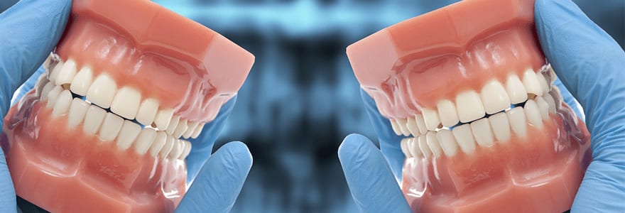 Implant Supported Dentures 7 Implant-Supported-Dentures1