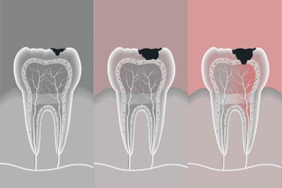 root-canel-thumbnail-image
